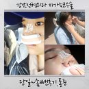 덜아픈세상레이저의료기 | 강남 코수술 내돈내산 후기1탄 자가늑 통증부터 솜 빼기 전후 변화까지 찐기록