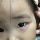세종안과의원 | 26개월 아기 다래끼 치료, 세종시 서울삼성안과 방문기