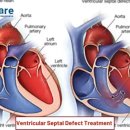 심실 중격 결손증[ventricular septal defect, VSD] 이미지