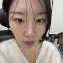 지성 | 리쥬란힐러 7일차, 속광 올라옴 후기 (지성피부 내돈내산 효과)