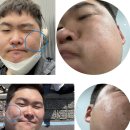 파란별한의원 | 새살침 후기 1년 6개월간의 치료를 마치며,, feat. 전후사진포함