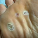 공생약국 | 사마귀.. 엔드와츠로 박멸하는 일기 , 뚜따후기!!!