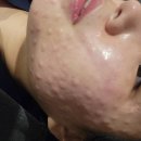 워크스 | 안양피부과 들뜨는 화장엔 스킨보톡스 물광주사 조합으로 해결