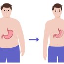 비만대사 수술[bariatric surgery] 이미지