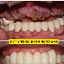 나우치과의원 | 인천 부평 부천 앞니 임플란트｜30대 틀니 환자, 뼈이식·잇몸이식으로 회복한 케이스