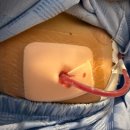 장튼위튼병원 | [장튼위튼병원] 담낭제거수술 후기 | 내돈내산 | 아맞블~~~🔥💪🏻