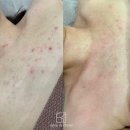 박수연에스테틱 - 포항시 북구 칠성천길 112-2 | 김포 구래동 등드름 바디필링 이벤트, 선착순 5명입니다
