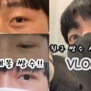 상덕의원 | [짝눈 매몰 쌍커플수술] 친구 쌍수 시켜주기 VOLGㅣ유튜브 상덕