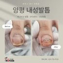 골프 | 양평내성발톱 교정, 자동문 충격과 골프화 압박으로 심해진 통증 해결 후기