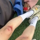새솔약국 | [찰과상/마찰화상]수원 화상 전문 병원 새솔외과의원(사진첨부)
