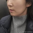 11305-15-600-1 | 선릉피부과 볼뉴머 600샷리프팅 볼뉴마이징 효과 후기