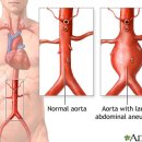 Abdominal aortic aneurysm_복부대동맥류 이미지