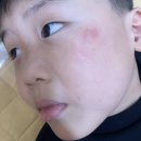 매직피부과의원 | 유치원에서 아이 얼굴에 유성매직... 지우다 피부 손상까지 (피부과 다녀온 후기)