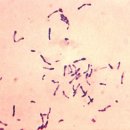 디프테리아 (Diphtheria) 이미지