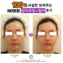 대전 실리프팅 전문 앞볼 팔자 꺼짐 볼살 쳐짐 실리프팅 필러 해결방법 (feat. 콜라겐 시술)