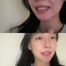 강남교정치과 30대가 되어서 시작한 윗니 부분교정 내돈내산 후기 블랑쉬치과
