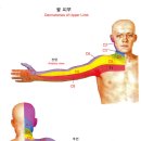 목 디스크와 전이통(연관통,referred pain) 이미지