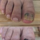문제성발톱, 발톱무좀관리 다락방