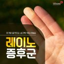 레이노 이미지