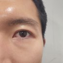 리안성형외과의원 | 노원역 쌍꺼풀 수술, 쌍수, 쌍꺼풀 재수술 feat. 리안성형외과