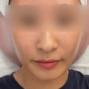 [춘천] 여름철 기미·잡티 관리! 미백케어 후기 뷰티오로라엘 본점