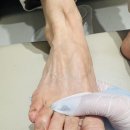 선화로73길 | 송천동 1가 내성 무좀 발톱 관리 후기, 달라진 점은 이것이었어요♥