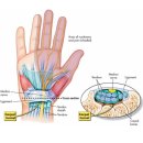 손목 수근관 증후군~ 이미지