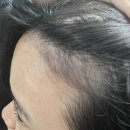 세미이비인후과의원 | 조합약까지 먹어봤던 내돈내산 모발이식 당일 후기 [병원 고르기, 비절개, 비용, 통증, 개구리알, 출혈 ]