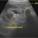 Renal calculus with hydronephrosis 수신증 동반 신결석 이미지