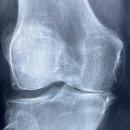 의료법인장산의료재단이춘택병원 | 무릎·어깨 아플 때 '전문병원' 마크 확인하셨나요? 관절 전문병원 지정 기준 7가지와 국내 관절전문...