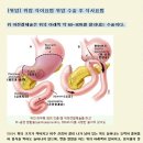 위암 식이요법 위암 수술 후 식사요법 이미지