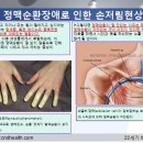 손저림 혹은 레이노드 증후군 이미지