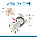 대퇴골두 무혈성 괴사!! 고관절 인공관절 수술을 해야 할까요? 이미지