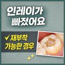 이재치과의원 | 인레이가 빠졌는데 안 아파요, 그냥 다시 붙이면 될까요? 재부착 증례