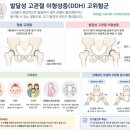 미즈유영상의학과의원 | 발달성 고관절 이형성증, 고위험군, 신생아 고관절 이형성증 초음파, 미즈유 영상의학과