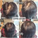 난곡동-52 | 60대 여성 새치 염색으로 모발이 점점 가늘어지는 정수리 탈모 리앤힐에서 프리미엄 탈모 관리 시작