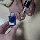 바를정한방병원 | &lt;바를정한방병원 신림&gt; 무좀 치료