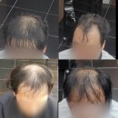 다큐디자인 | 영구 두피문신 잘하는 전문 미용실이 추천하는 넓은 이마에 어울리는 두피문신 디자인 그리고 후기와 리뷰