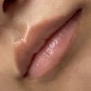 해명메디칼 | 구순염 꺼지라고(1)