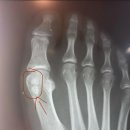 건우한의원 | 종자골염, 그로 인한 종자골 절제술 후기 (1)