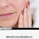 베체트병 및 검사 (구강 입속 궤양) 이미지