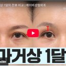 에이비 시스템 | 50대 이마거상 수술 1개월 후기 | 실제 변화와 관리법 총정리 ✨ | 도경현 원장 | 에이비(AB) 성형외과