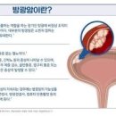 남성 방광암 ＜원인증상예방＞ 방광암 노출 위험 직업군 이미지