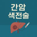 간암 색전술 이미지