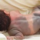 몽고반점 이미지