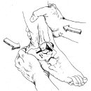 발목관절의 ROM과 안정성 검사 이미지