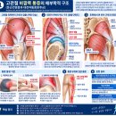 고관절 바깥쪽 통증 완화 운동｜둔근건병증 재활운동 이미지