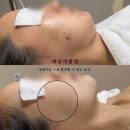 정노화방지연구소 | (스킨부스터) 효과빠른관리, 여신의발견에서 이벤트케어 꼭 받으셔야만해요!