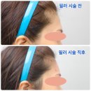 조에피부과 네이버블로그