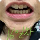 더원치과교정과치과의원 | 교정일기 4 (앞니가 붙었어요. 투명교정 30대 후기, feat. 구리더원교정치과)